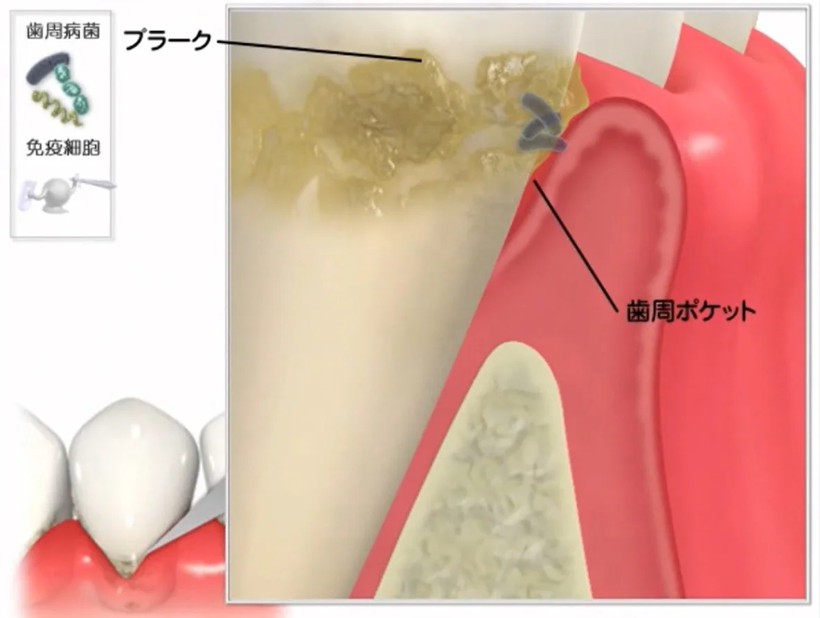 繊維が断裂して歯周ポケットが形成された断面図