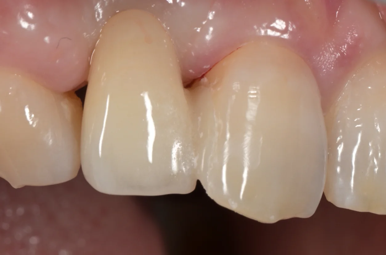 審美治療+歯質保存：延長セラミックブリッジ｜坂寄歯科医院（取手市藤代） - 画像5