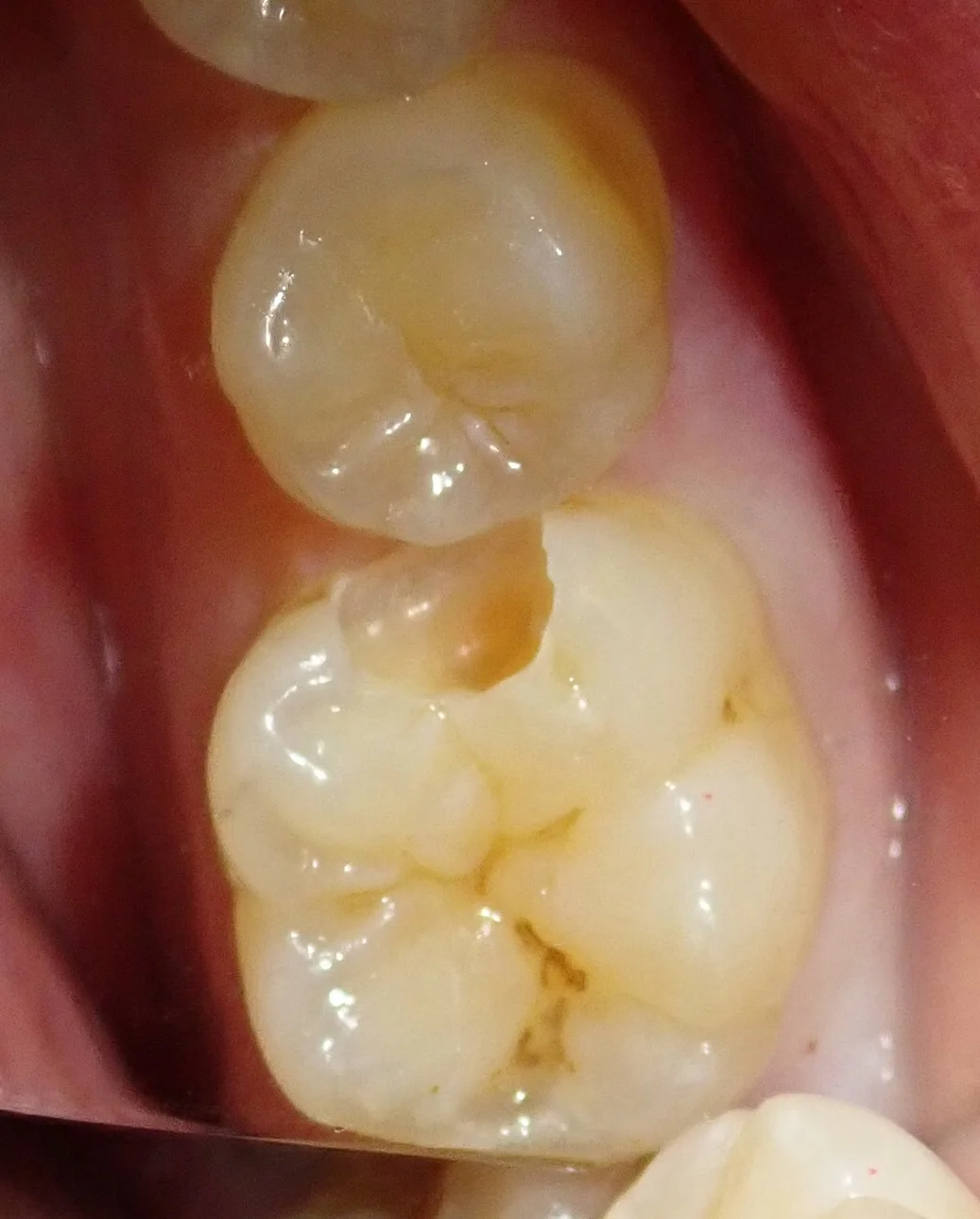 虫歯はない･･･?本当に･･･?｜坂寄歯科医院（取手市藤代） - 画像3
