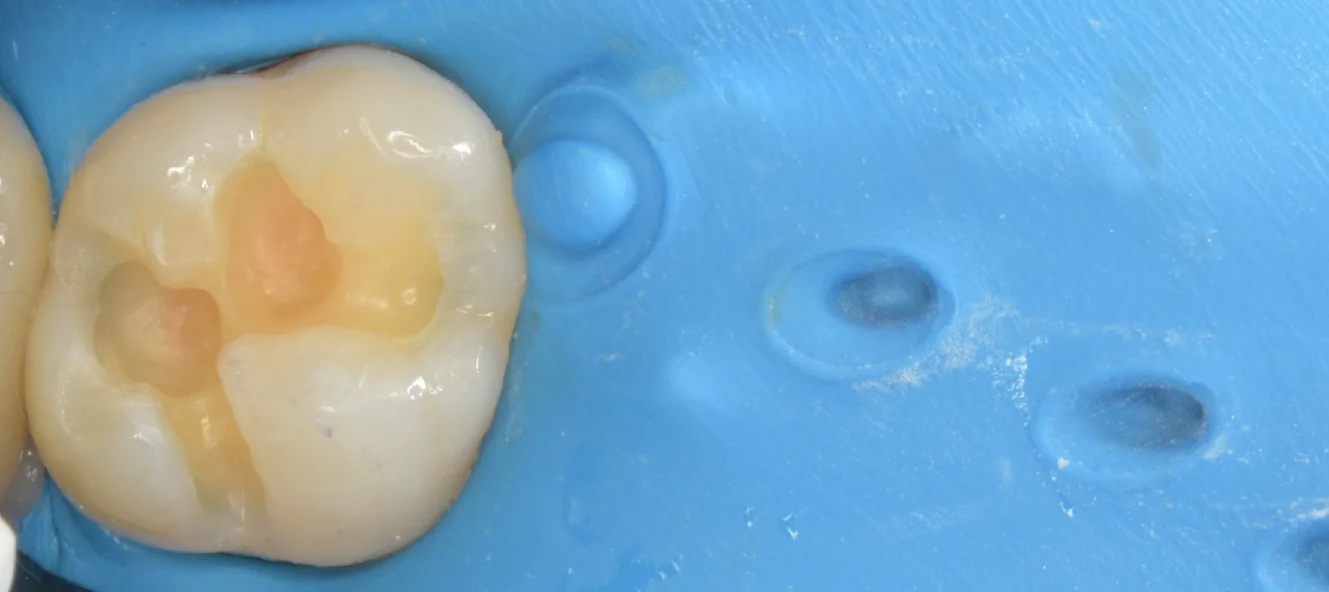 自費の白い詰め物。｜坂寄歯科医院（取手市藤代） - 画像3