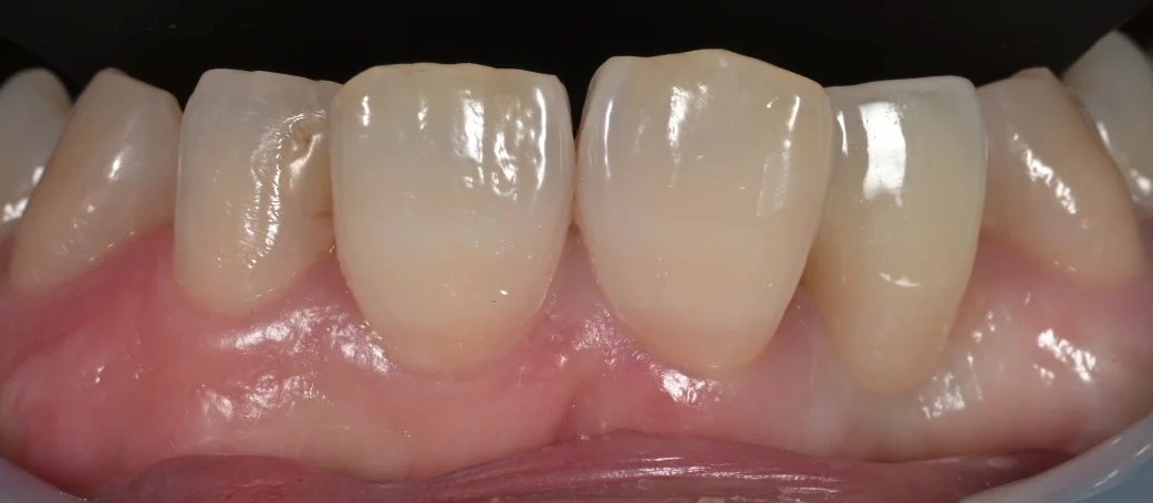 審美治療+歯質保存：延長セラミックブリッジ｜坂寄歯科医院（取手市藤代） - 画像2
