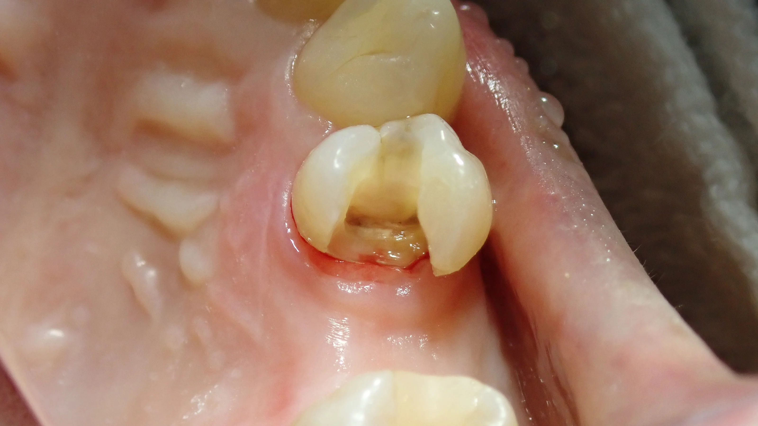 ダイレクトボンディング④｜坂寄歯科医院（取手市藤代） - 画像3