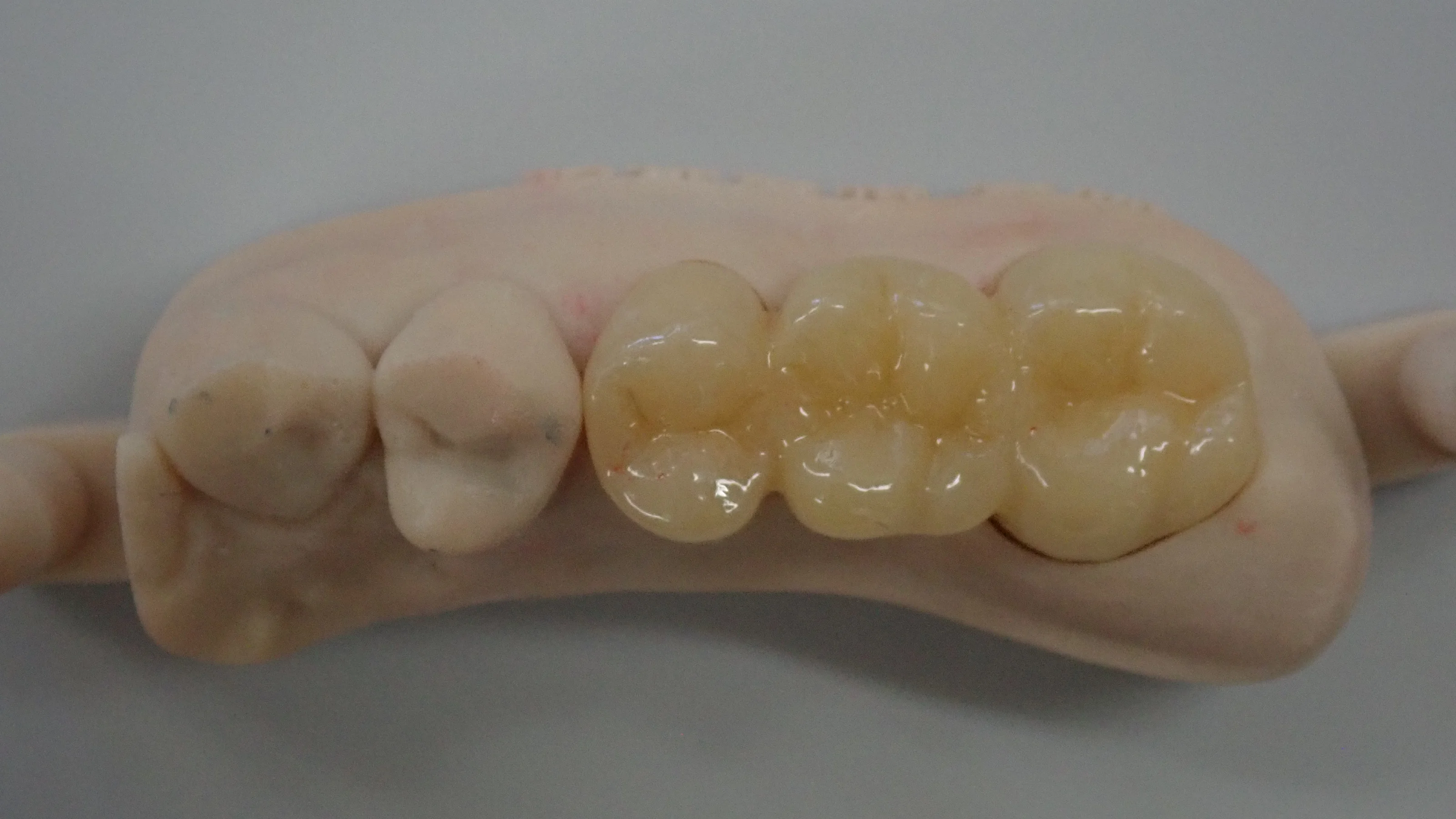 奥歯のセラミックブリッジ｜坂寄歯科医院（取手市藤代） - 画像3