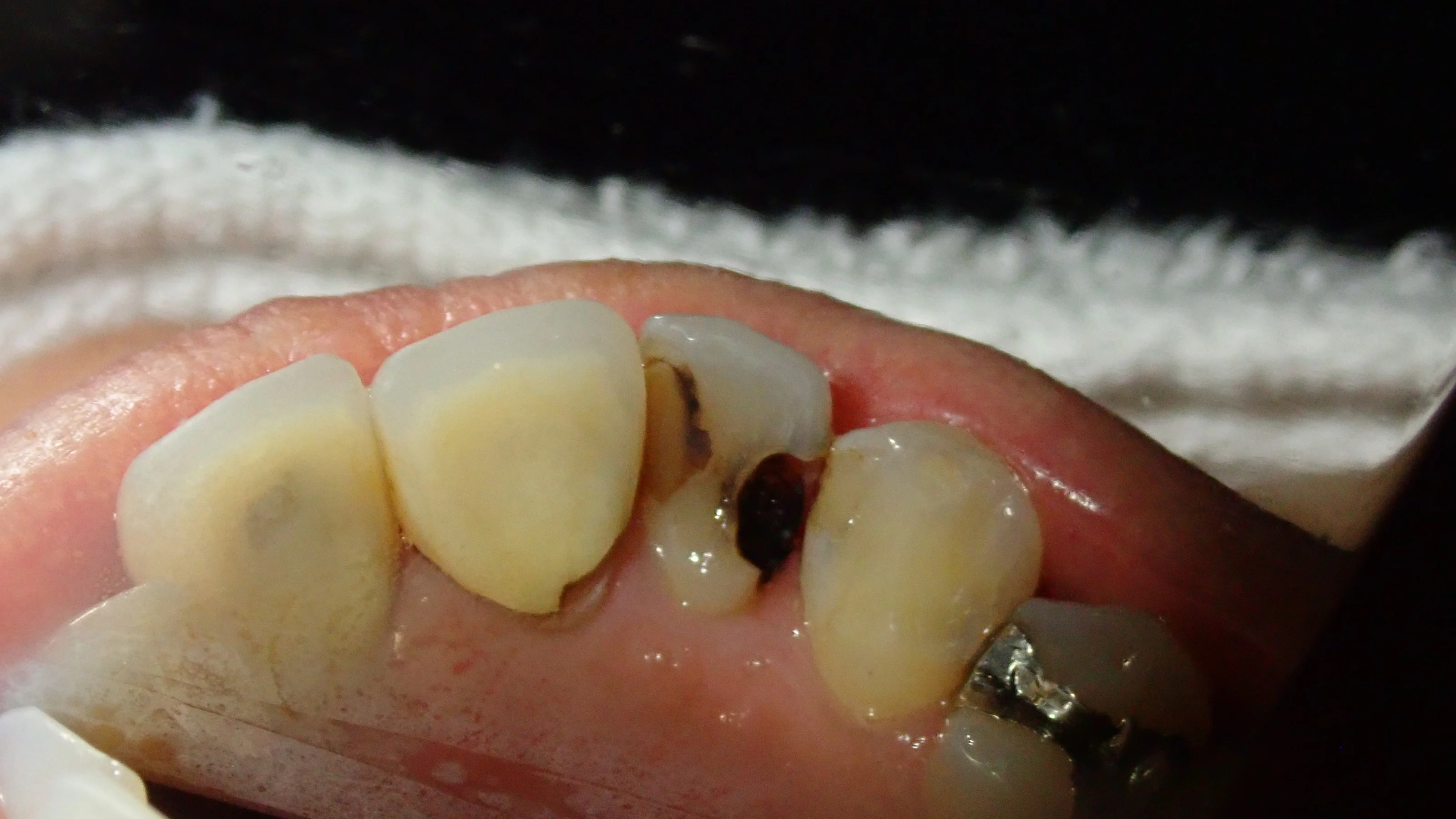 前歯ダイレクトボンディング｜坂寄歯科医院（取手市藤代） - 画像2