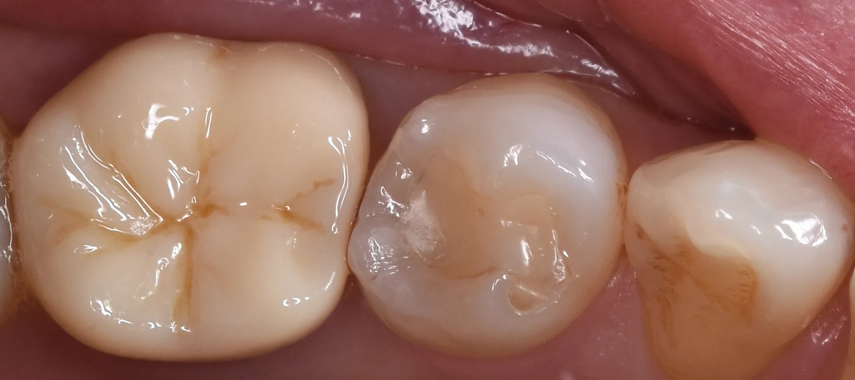 セラミックの被せ物｜坂寄歯科医院（取手市藤代） - 画像5