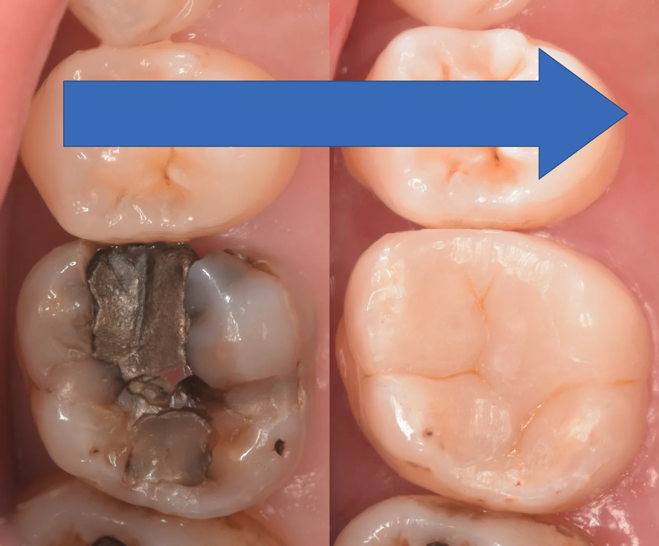 歯科医師の方を治療。｜坂寄歯科医院（取手市藤代） - 画像6
