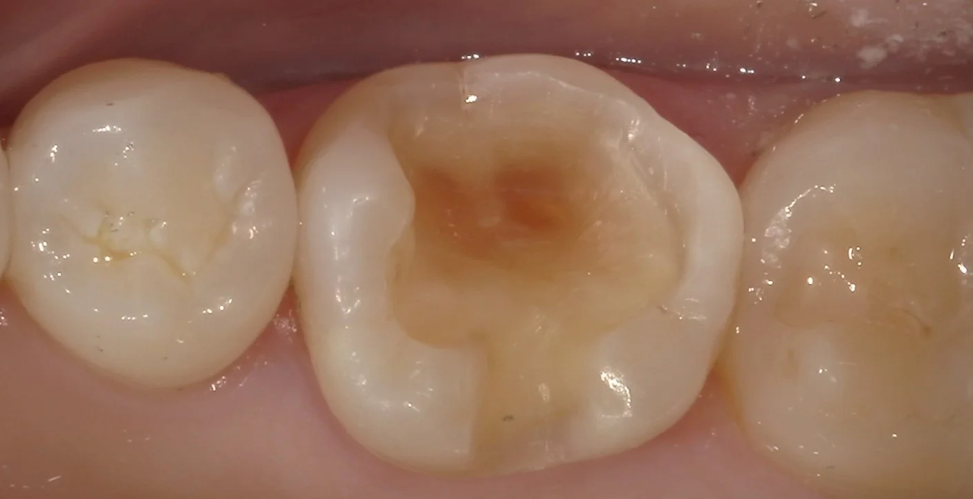 他院勤務中の歯科衛生士さんの治療を行いました。｜坂寄歯科医院（取手市藤代） - 画像2