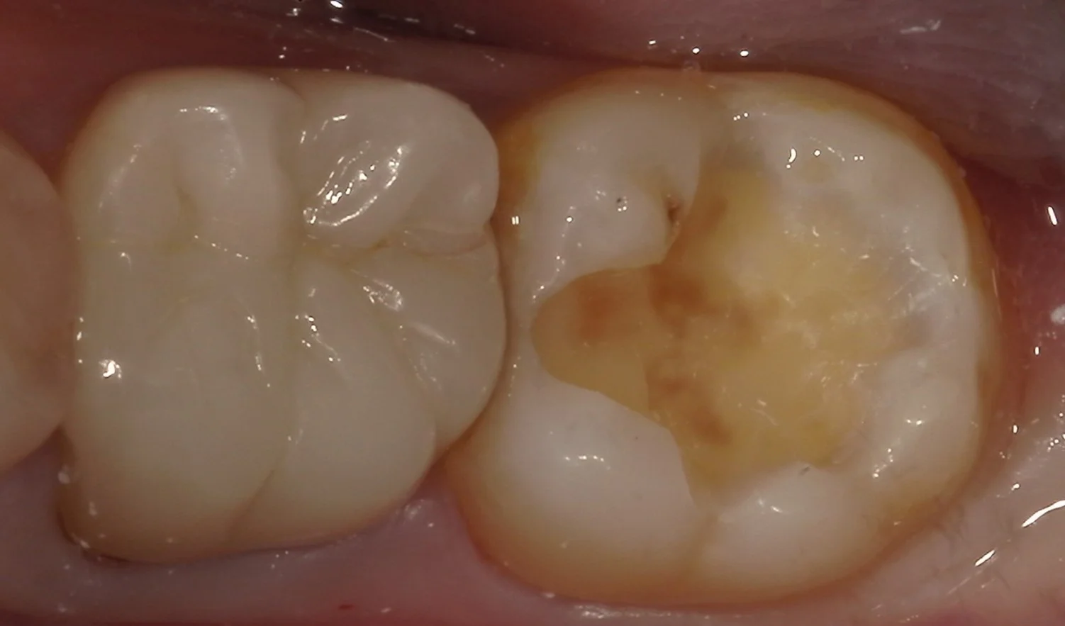 遠方より虫歯の治療で通院された方を一日で治療しました。｜坂寄歯科医院（取手市藤代） - 画像3