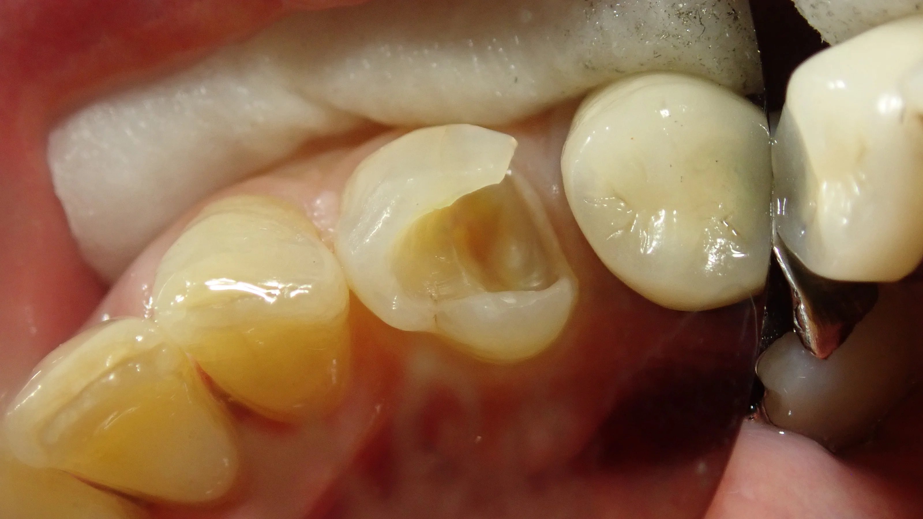 ダイレクトボンディング｜坂寄歯科医院（取手市藤代） - 画像3