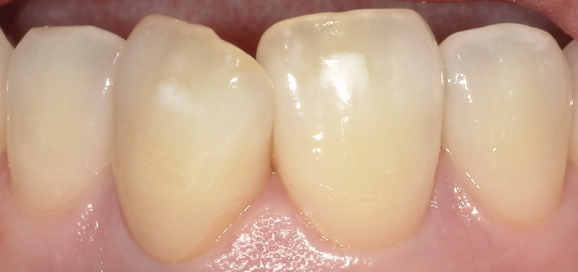 ICON治療(低侵襲ホワイトスポット改善治療)を始めました。|坂寄歯科医院(取手市藤代) - 画像2