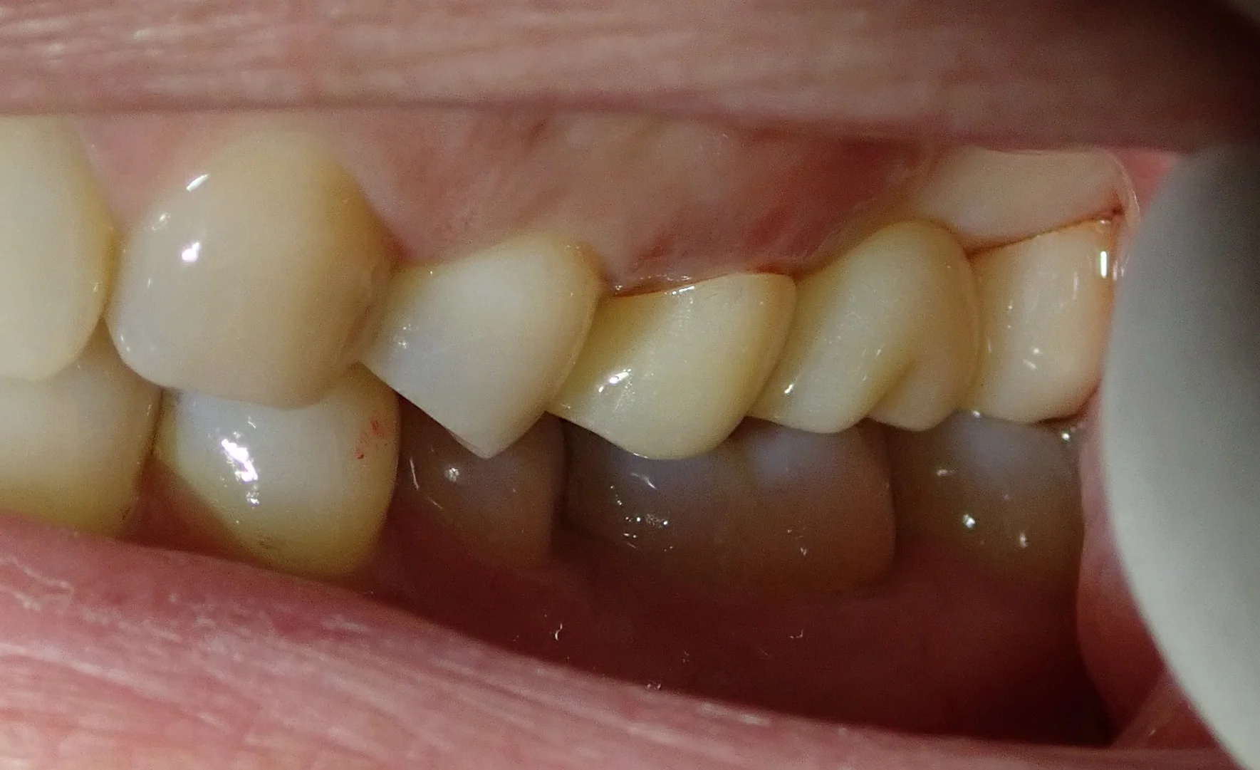 奥歯のセラミックブリッジ｜坂寄歯科医院（取手市藤代） - 画像5