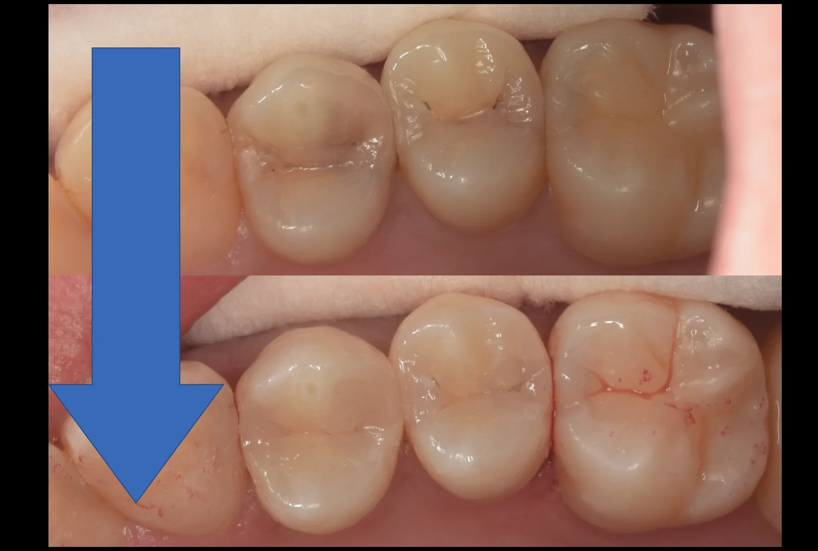 通常の保険診療。｜坂寄歯科医院（取手市藤代） - 画像5