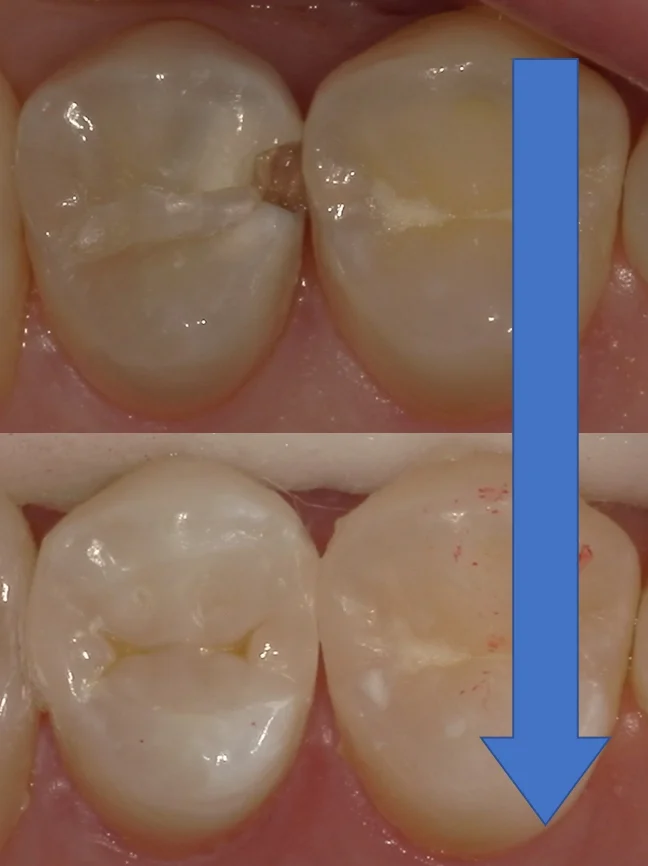 歯科医師の方の虫歯治療。｜坂寄歯科医院（取手市藤代） - 画像5
