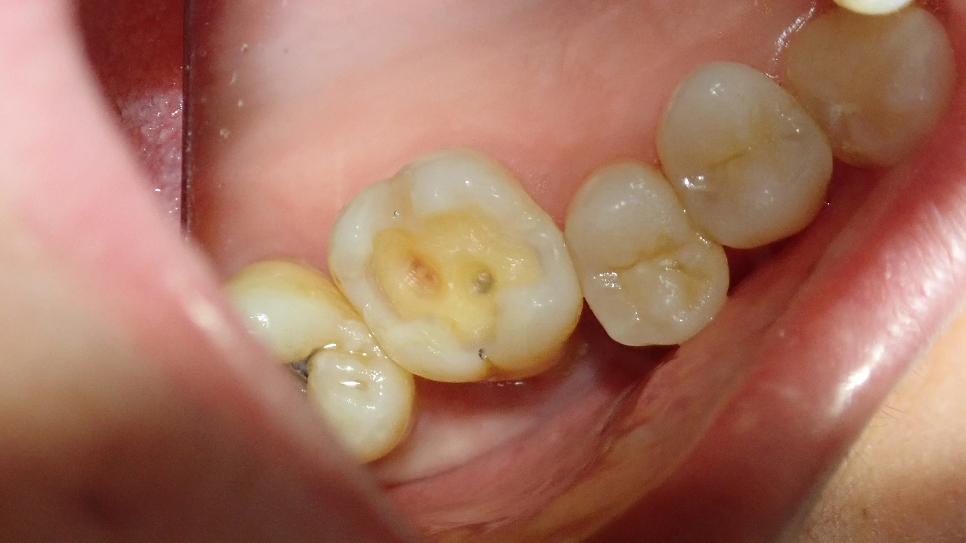 右上6ダイレクトボンディング｜坂寄歯科医院（取手市藤代） - 画像3