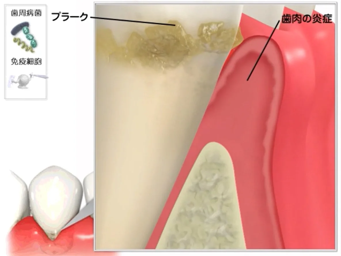 歯肉に炎症が起きて腫れた状態の断面図（歯肉炎）
