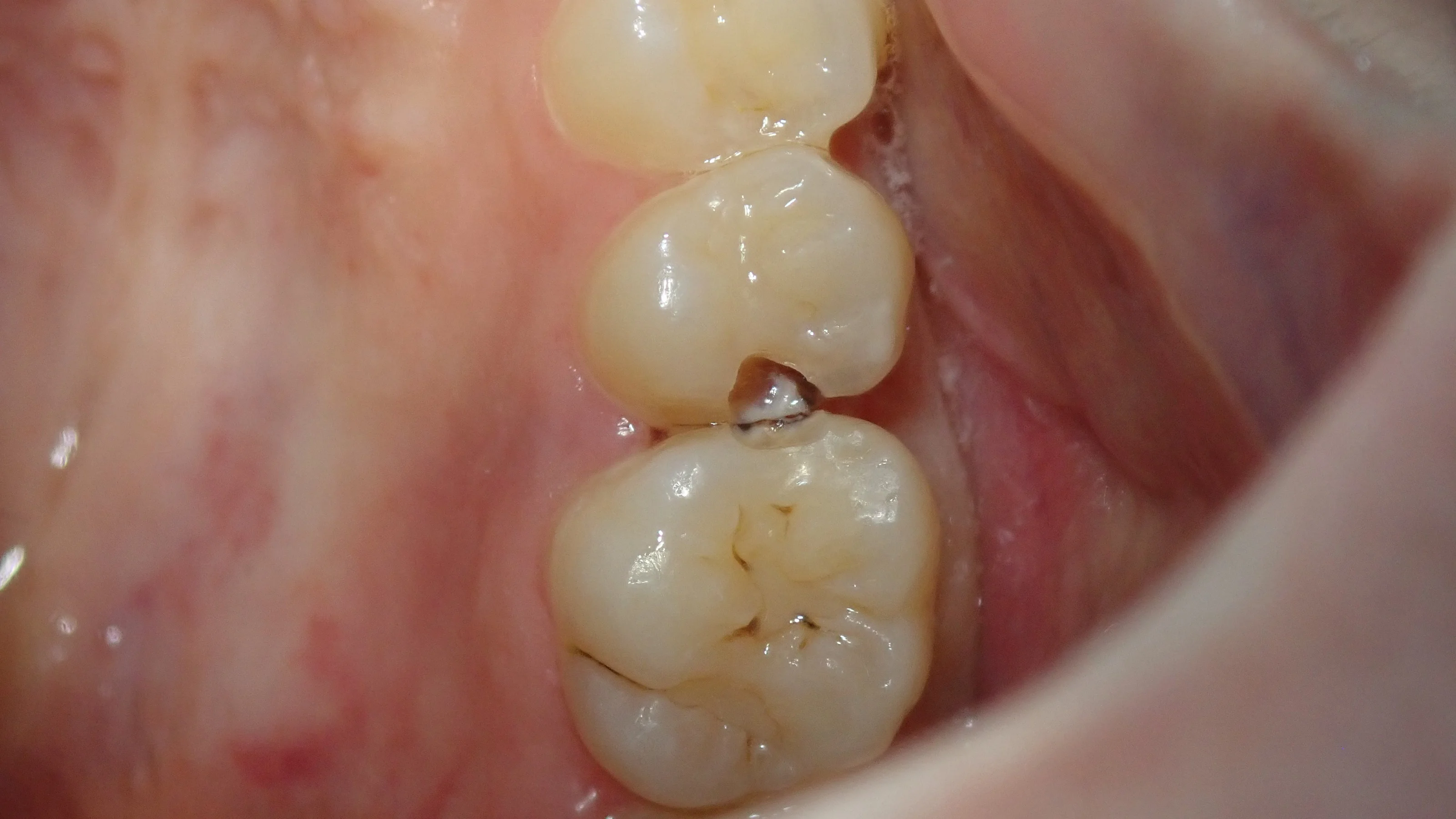 コンポジットレジン②|坂寄歯科医院(取手市藤代) - 画像2