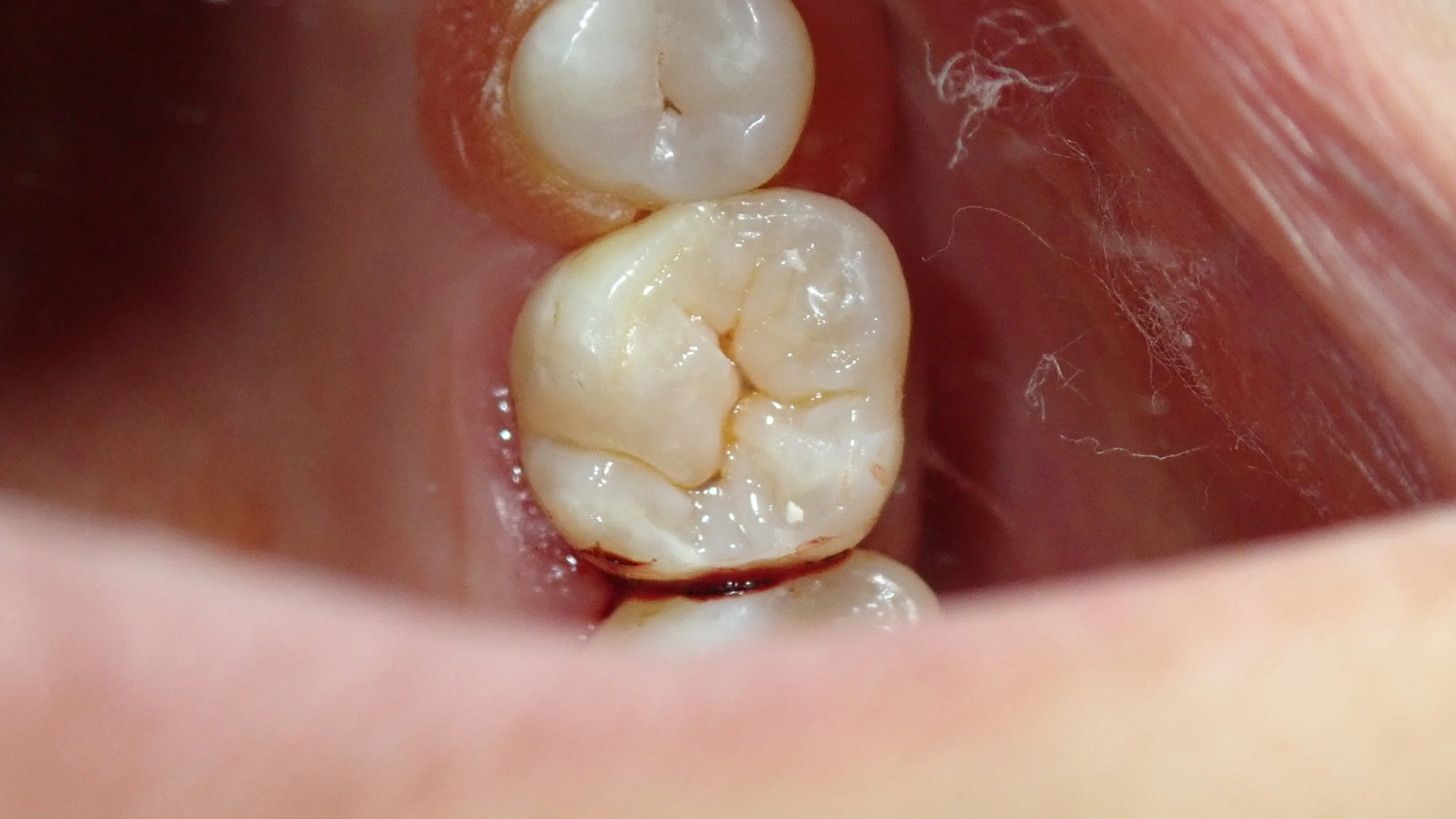 ダイレクトボンディング③(臼歯)|坂寄歯科医院(取手市藤代) - 画像4