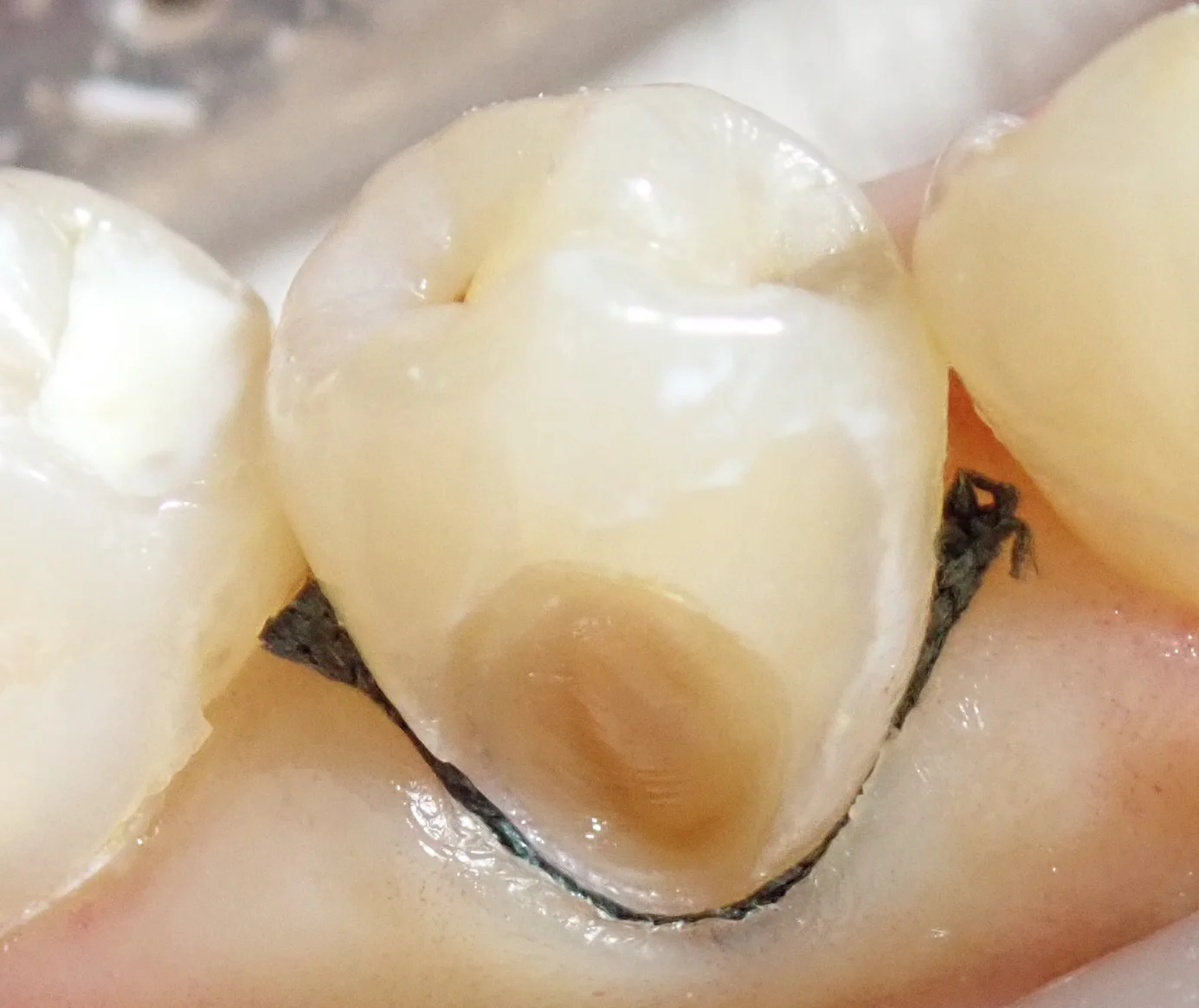 圧排糸を使ったレジン治療。｜坂寄歯科医院（取手市藤代） - 画像4