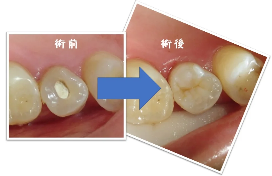 上顎小臼歯ダイレクトボンディング｜坂寄歯科医院（取手市藤代） - 画像4