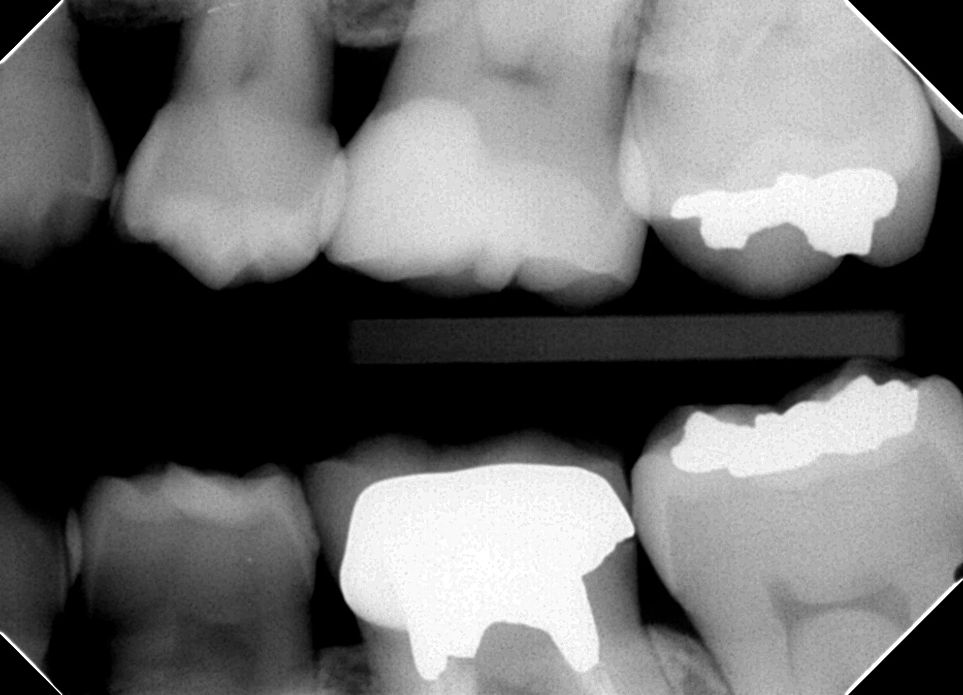 バイトウイング像（左上臼歯部）。Giomer併用コンポジット修復の近遠心マージンと接触点を確認。辺縁適合は良好で、術後2年時点で明らかな二次う蝕所見なし。