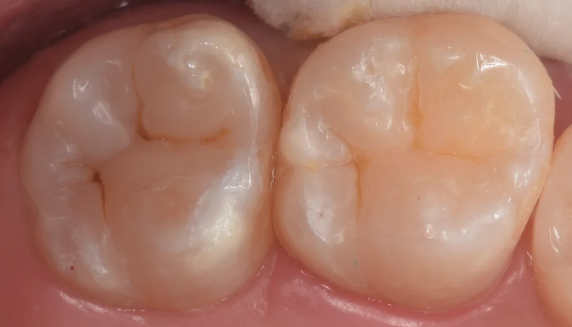 他院で入れたセラミックをダイレクトボンディングに。|坂寄歯科医院(取手市藤代) - 画像4