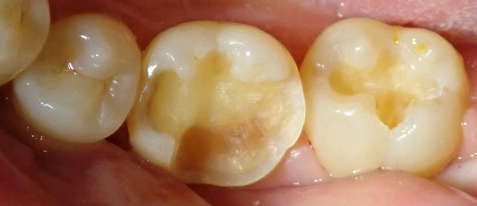 奥歯の白い詰め物｜坂寄歯科医院（取手市藤代） - 画像3