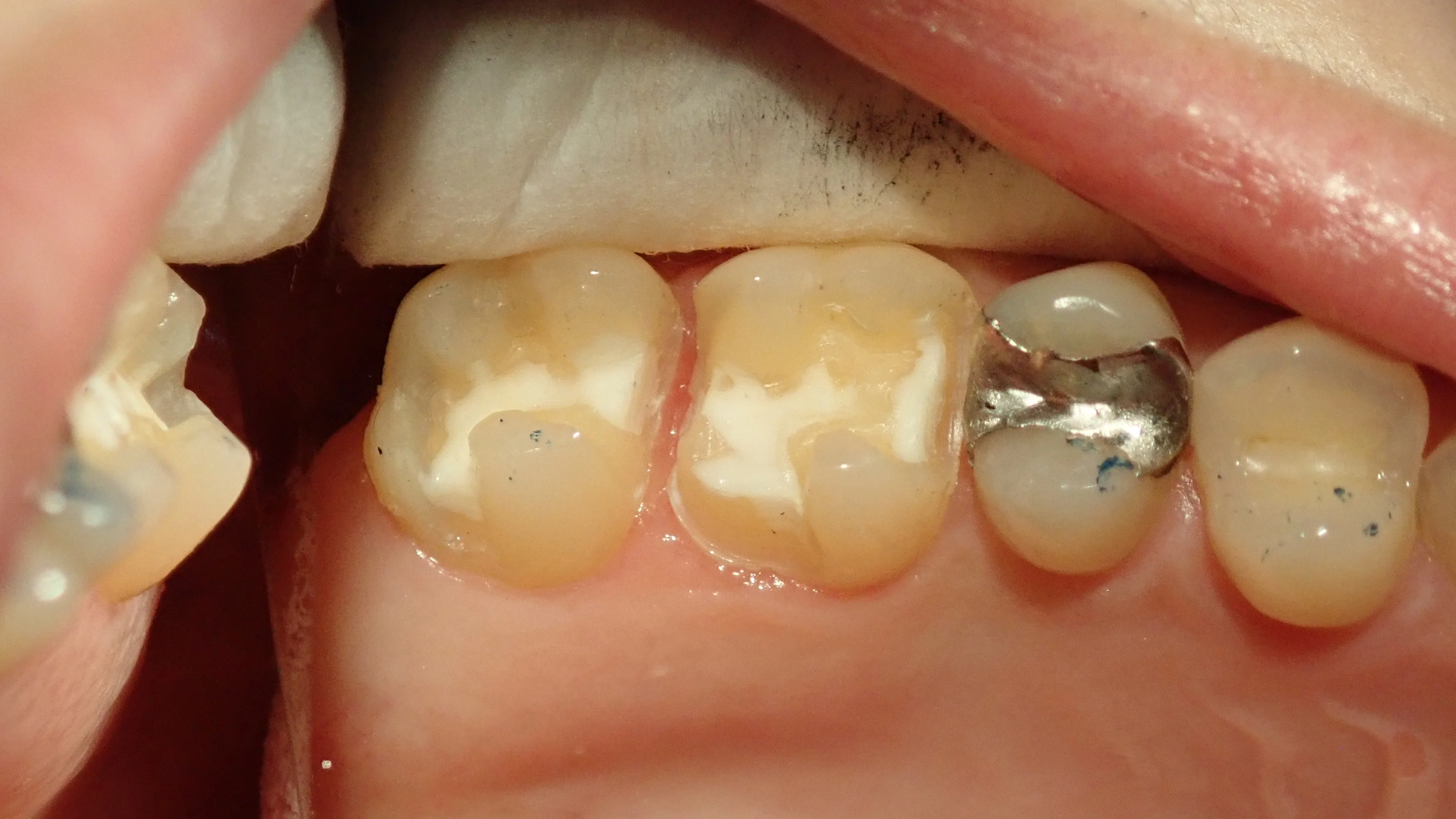 メタルインレー｜坂寄歯科医院（取手市藤代） - 画像3