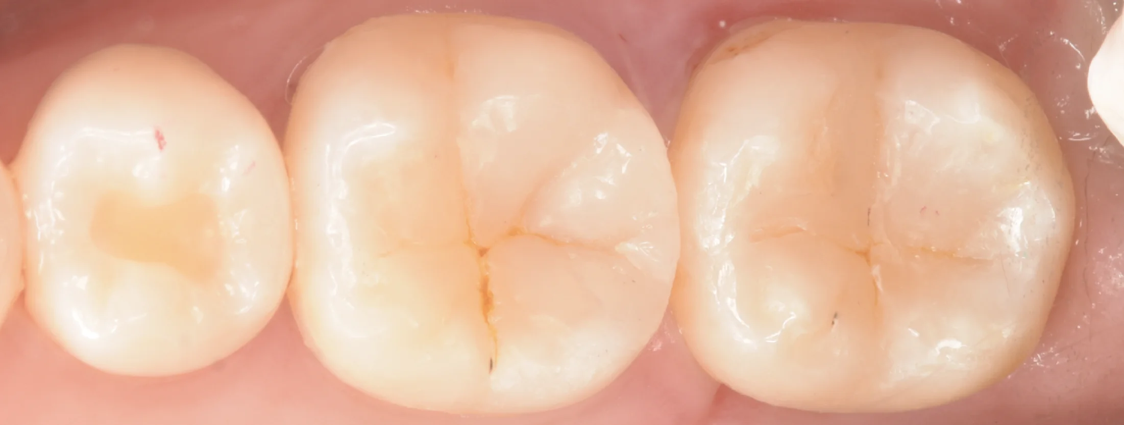 歯科医師の方のCAD/CAMインレーを治療。｜坂寄歯科医院（取手市藤代） - 画像8