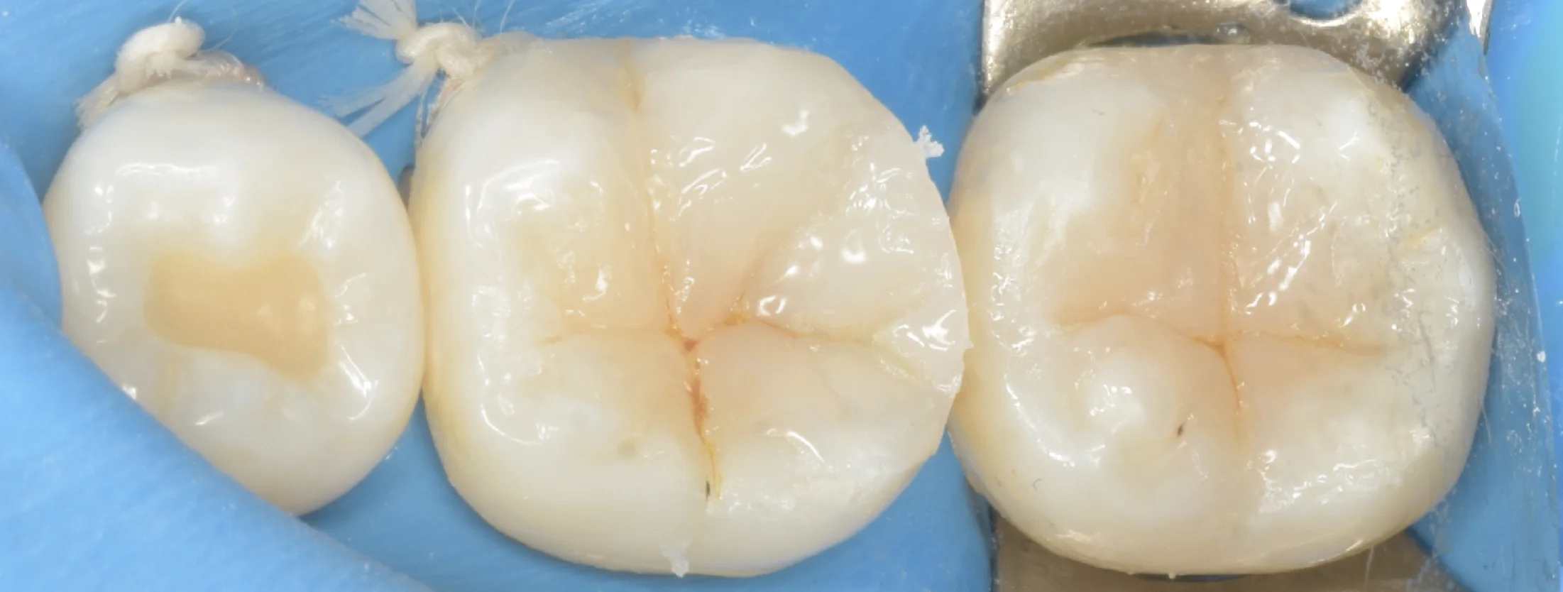 歯科医師の方のCAD/CAMインレーを治療。｜坂寄歯科医院（取手市藤代） - 画像7