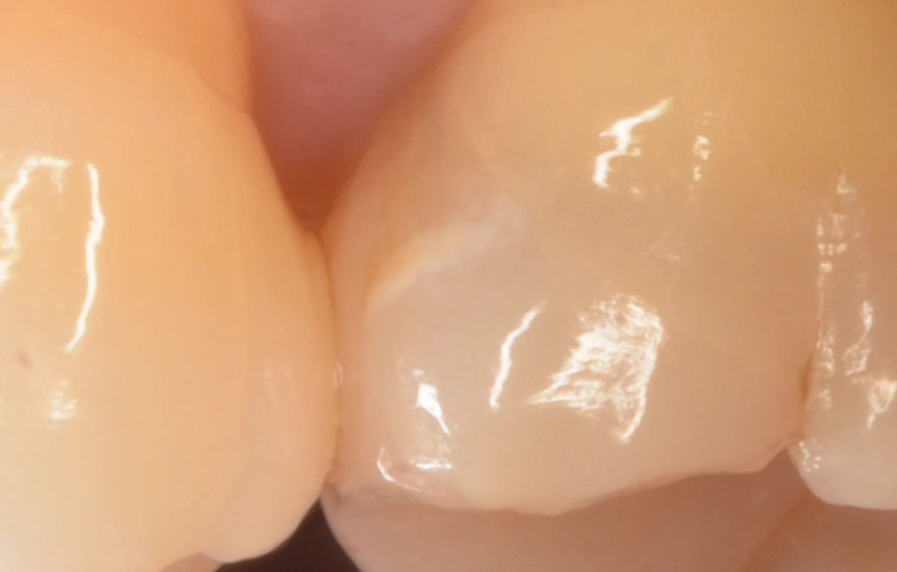 左上第1大臼歯（#26）のダイレクトボンディング修復。歯肉縁下約2mmからマージンを立ち上げ、歯頸部マージンにGiomerを選択。術後2年経過時の口腔内写真で、歯肉の発赤・腫脹およびCR表面のプラーク付着は明らかな所見なし。