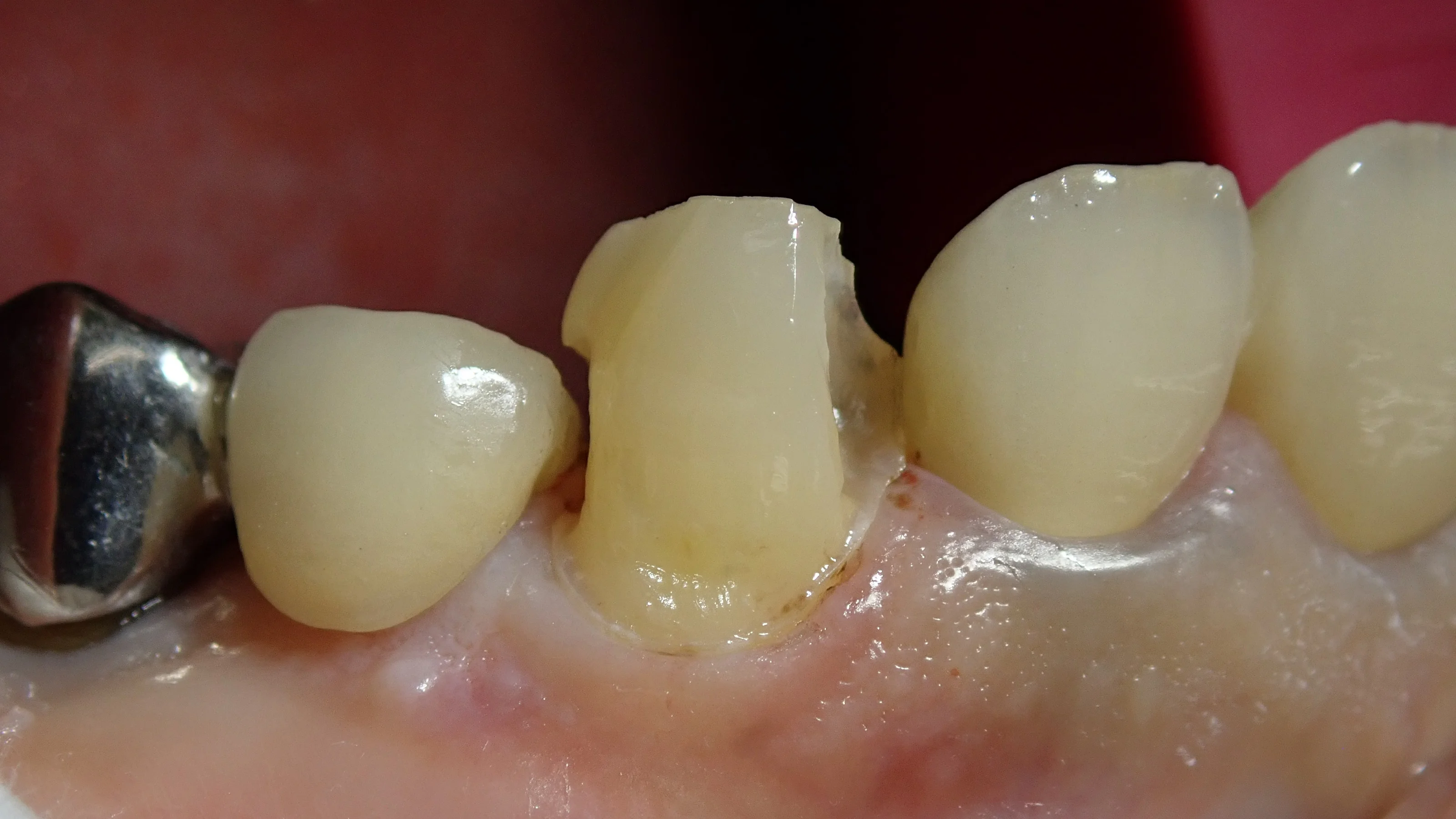 犬歯ダイレクトボンディング｜坂寄歯科医院（取手市藤代） - 画像3