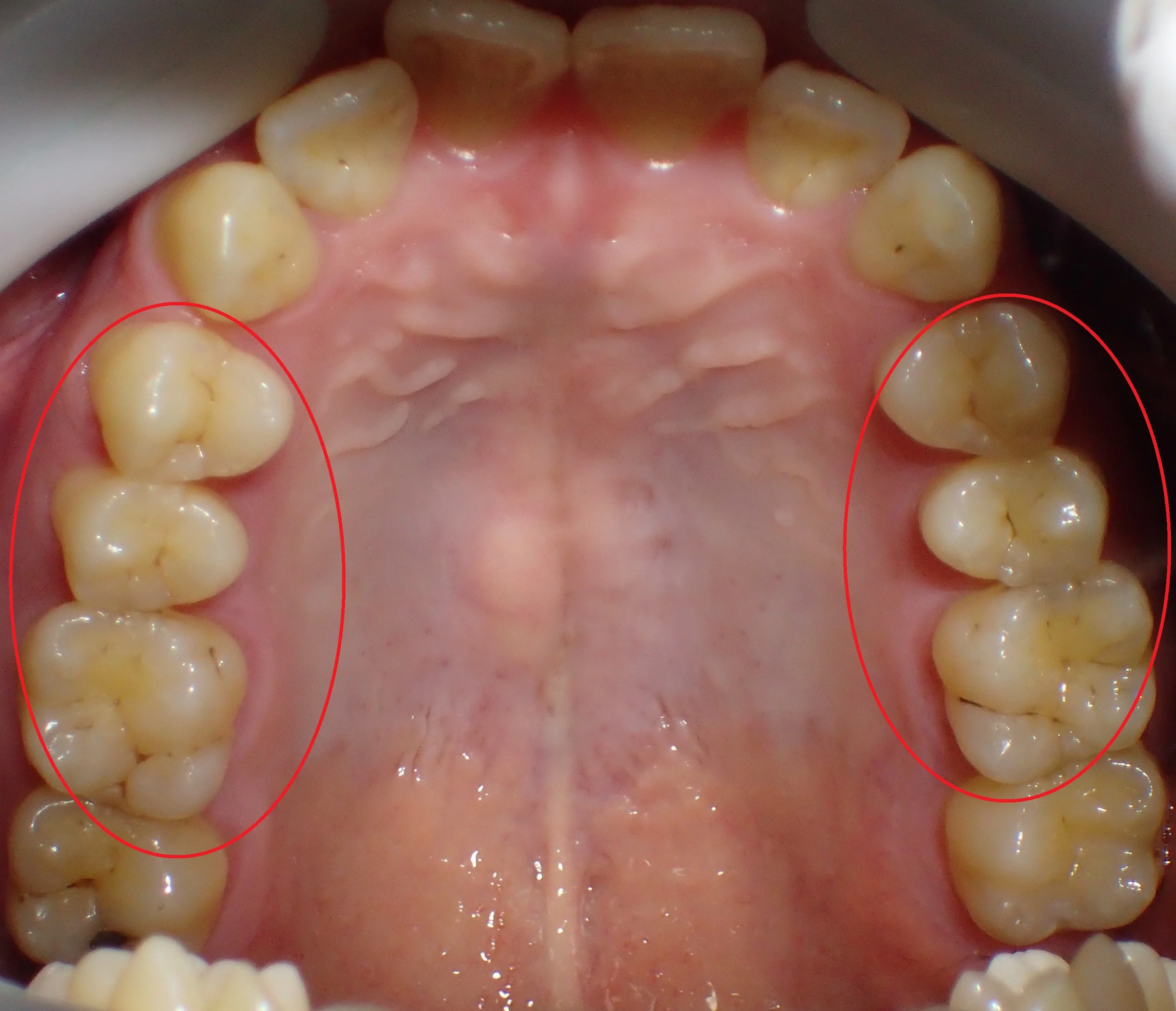 ダイレクトボンディングによる治療｜坂寄歯科医院（取手市藤代） - 画像3