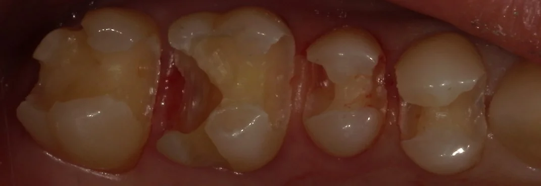 全体的に金属を白い詰め物に。｜坂寄歯科医院（取手市藤代） - 画像3