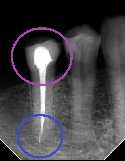 レジンでは無理ですって！｜坂寄歯科医院（取手市藤代） - 画像3