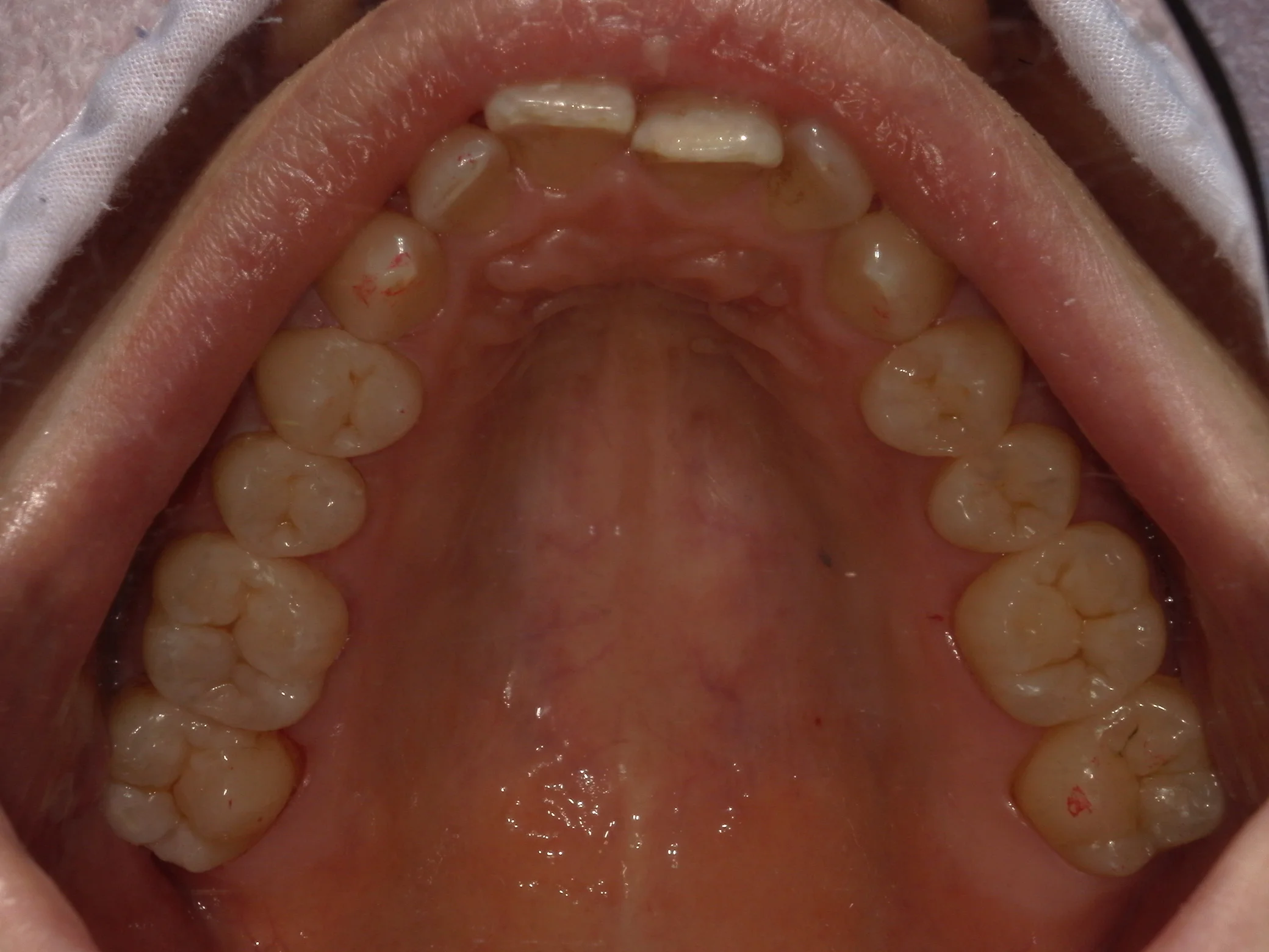 全体的に金属を白い詰め物に。｜坂寄歯科医院（取手市藤代） - 画像6