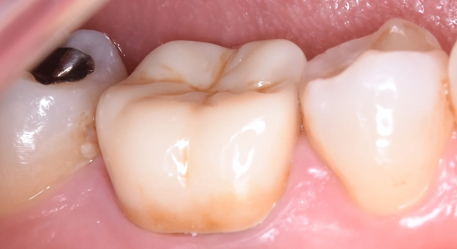 セラミックの被せ物｜坂寄歯科医院（取手市藤代） - 画像3