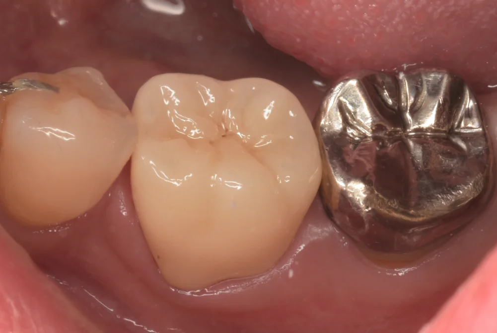 神経の治療後をセラミックで。｜坂寄歯科医院（取手市藤代） - 画像3