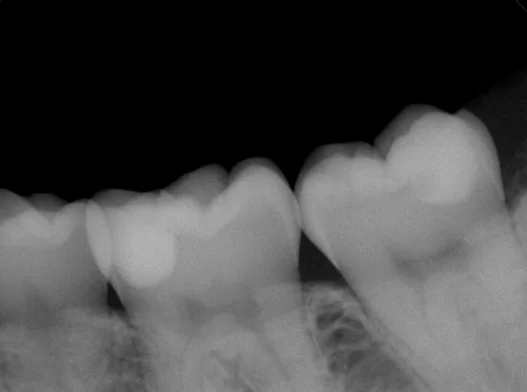 浦安から来た方をダイレクトボンディングで。｜坂寄歯科医院（取手市藤代） - 画像5