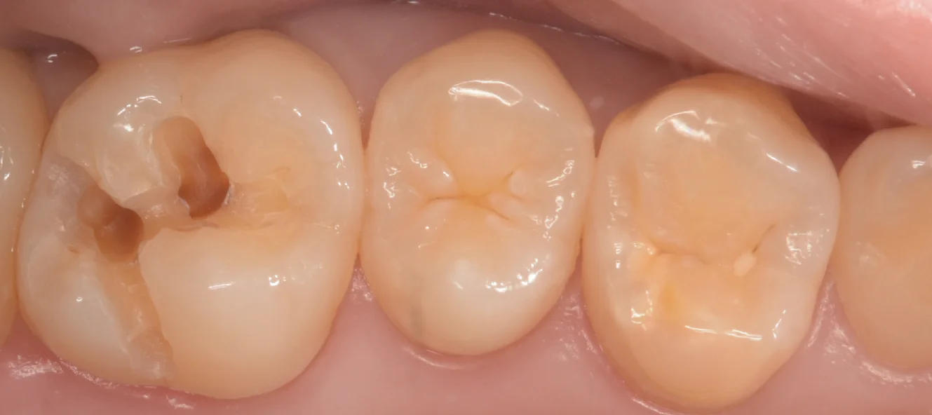 自費の白い詰め物。｜坂寄歯科医院（取手市藤代） - 画像2
