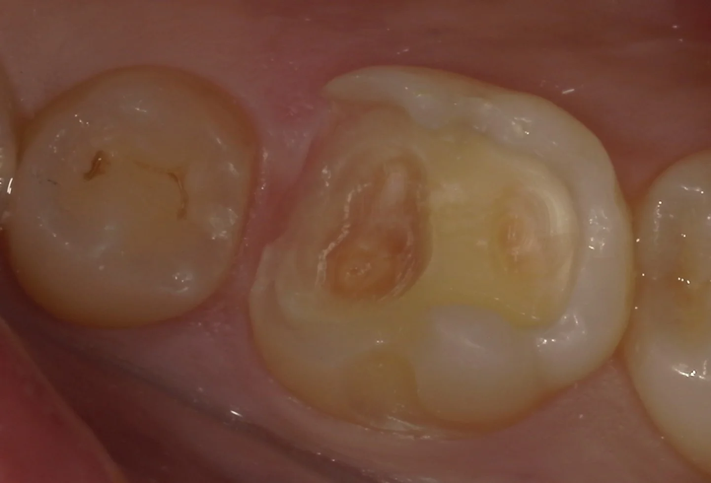 難易度の高い白い詰め物。｜坂寄歯科医院（取手市藤代） - 画像4