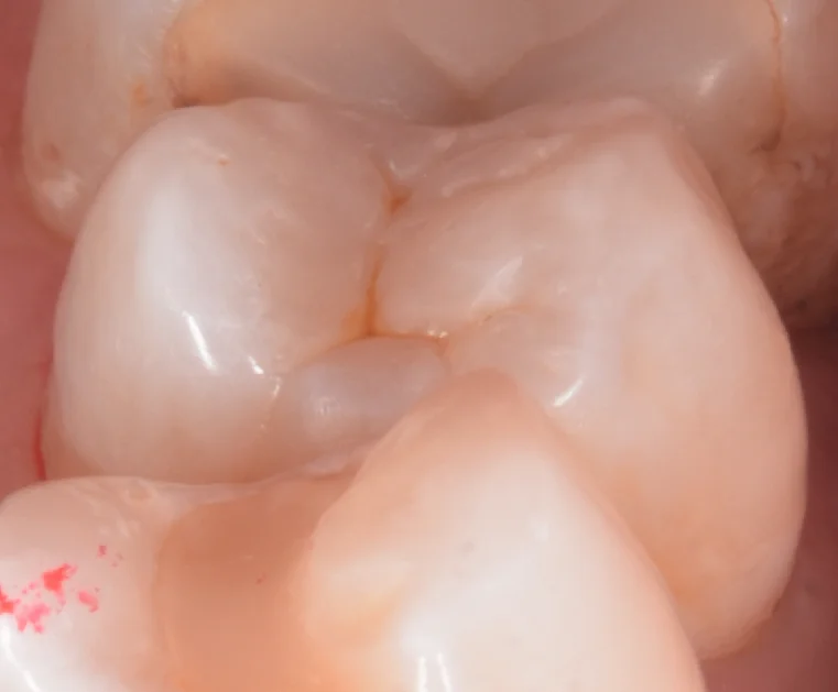 開業歯科医師の方を治療。｜坂寄歯科医院（取手市藤代） - 画像5