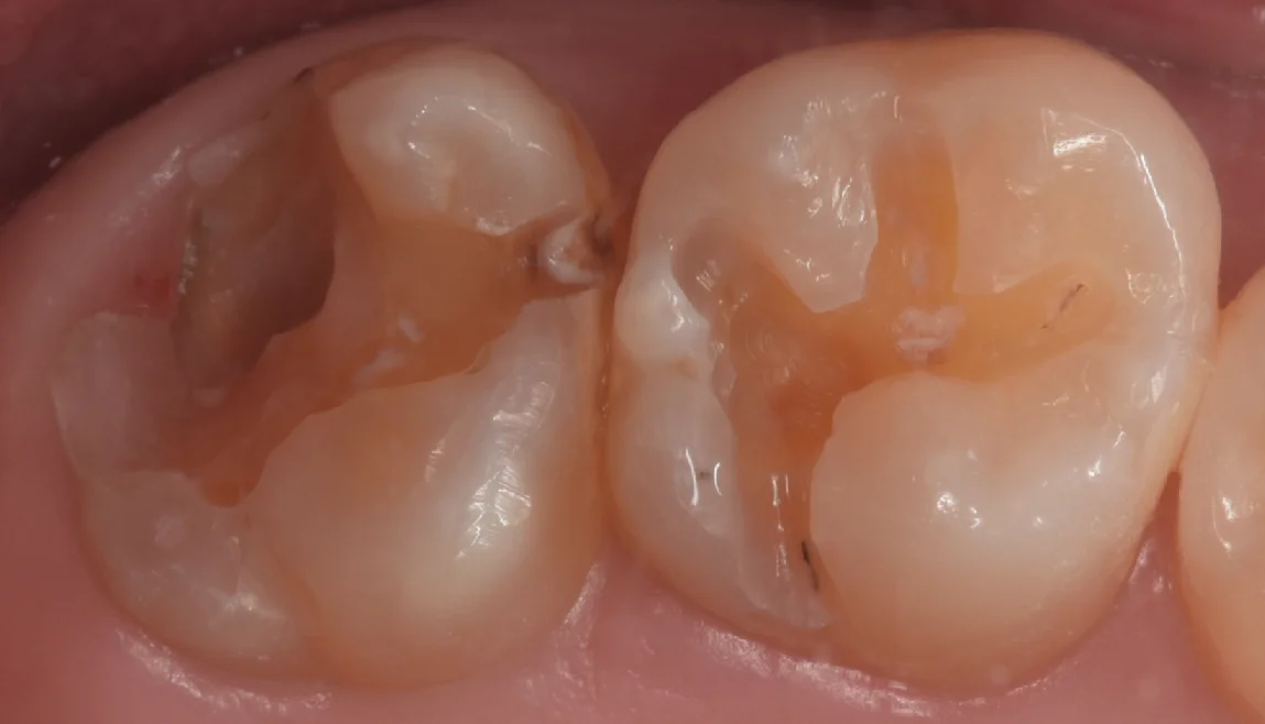 他院で入れたセラミックをダイレクトボンディングに。|坂寄歯科医院(取手市藤代) - 画像2