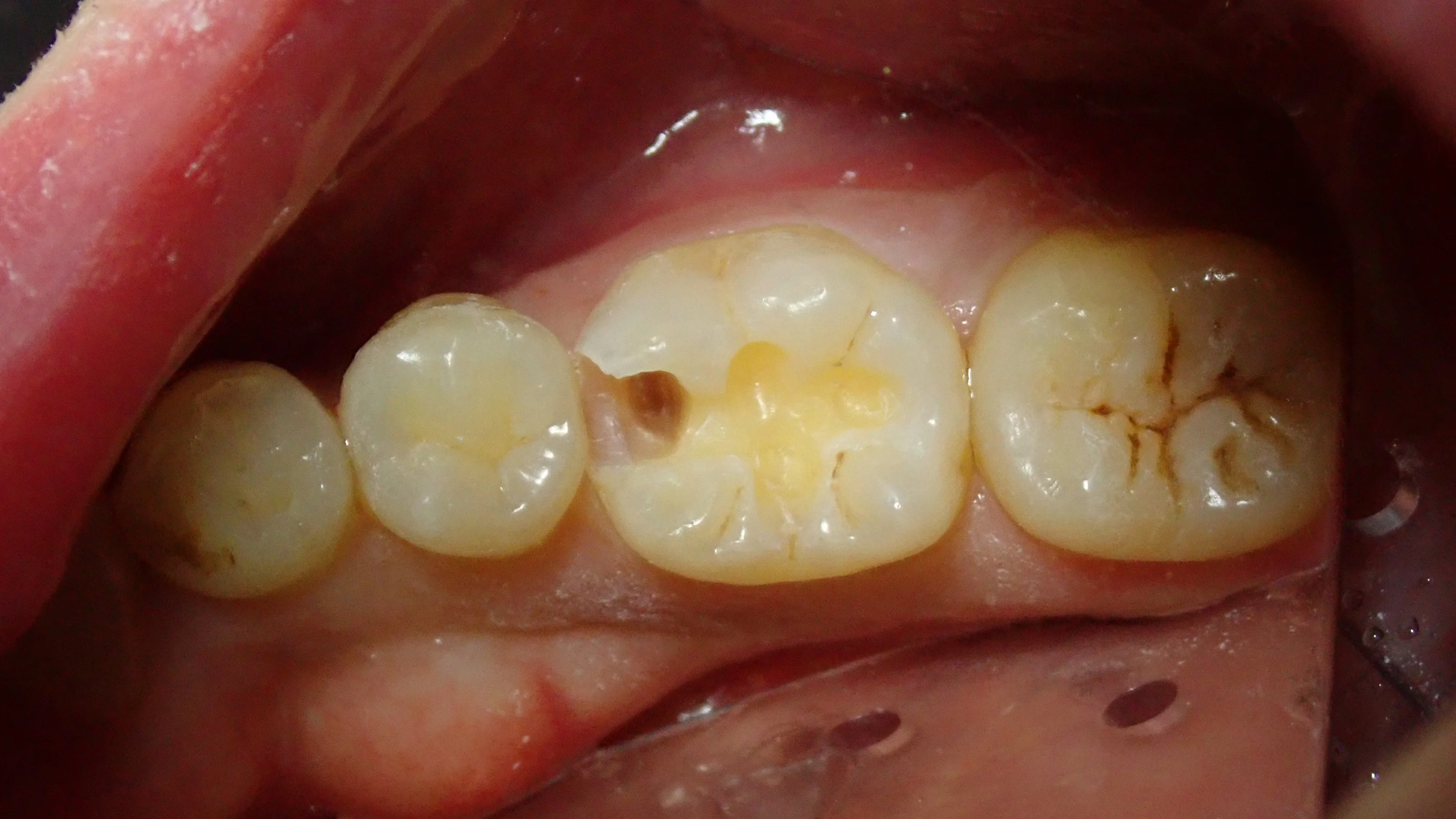 ダイレクトボンディング⑧｜坂寄歯科医院（取手市藤代） - 画像4