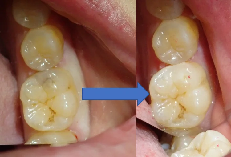 虫歯はない･･･?本当に･･･?｜坂寄歯科医院（取手市藤代） - 画像5
