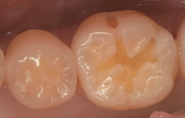 様子を見ていた所が進んだため治療介入。｜坂寄歯科医院（取手市藤代） - 画像3