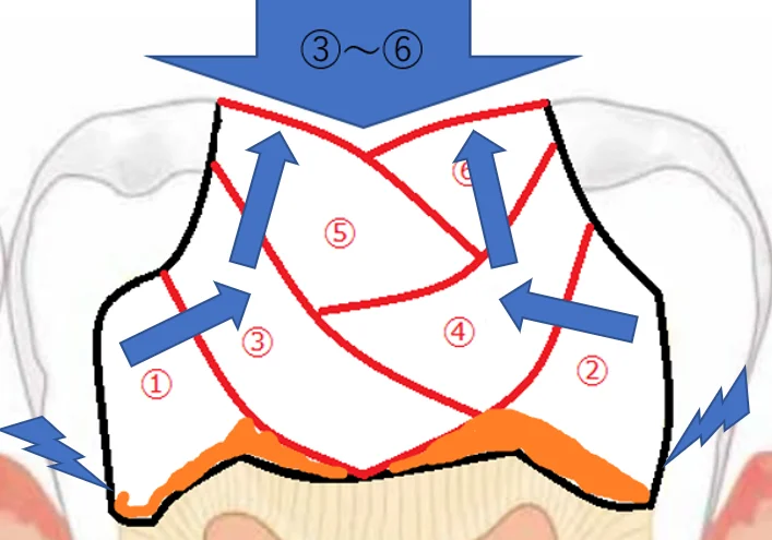 【歯科医師向け】重合収縮のコントロールについて【1級窩洞編】｜坂寄歯科医院（取手市藤代） - 画像7