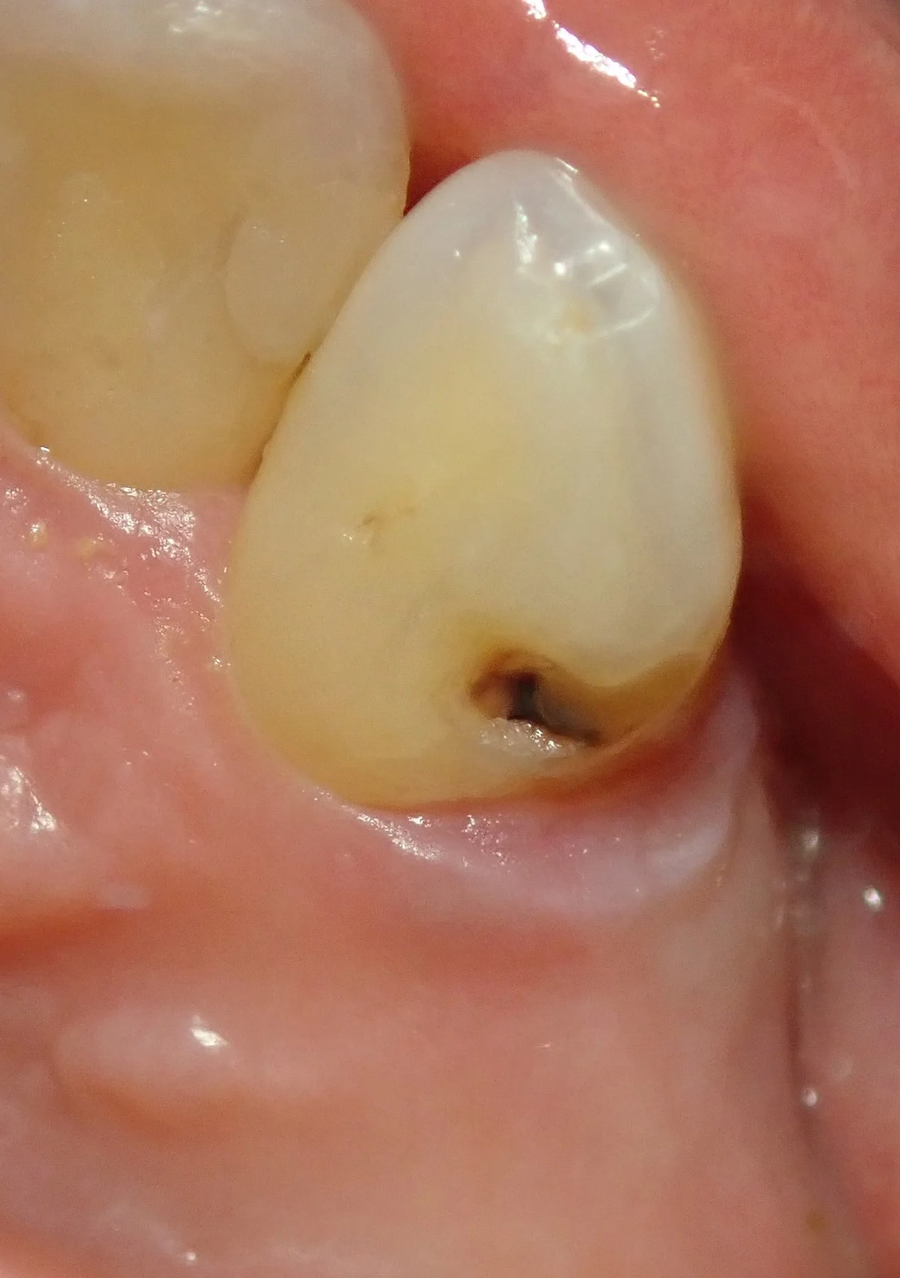 右上犬歯の白い詰め物｜坂寄歯科医院（取手市藤代） - 画像2