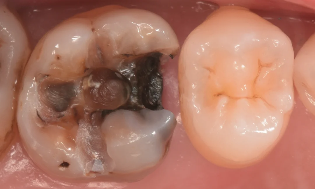 歯科医師の方を治療。｜坂寄歯科医院（取手市藤代） - 画像2