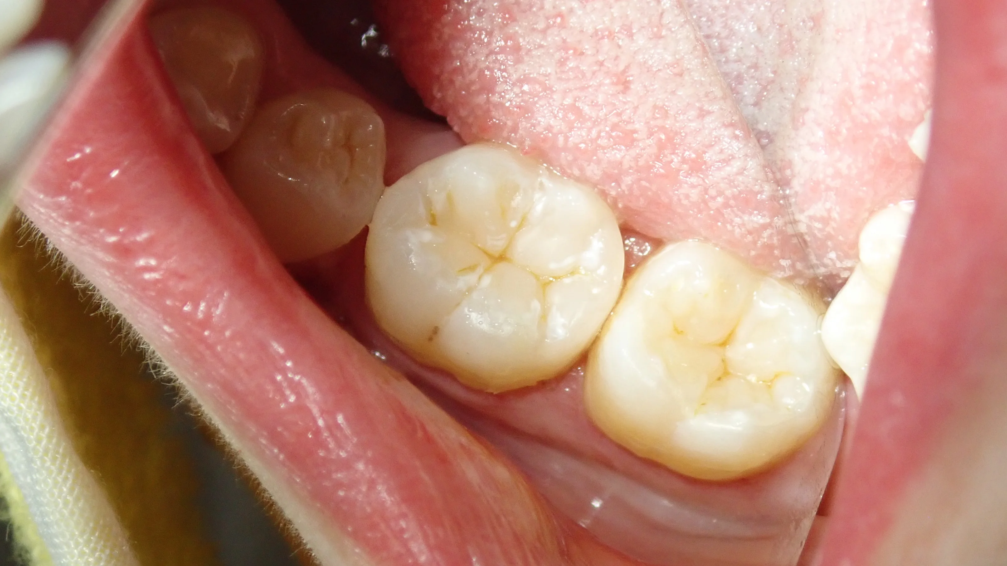 奥２本のダイレクトボンディング｜坂寄歯科医院（取手市藤代） - 画像7