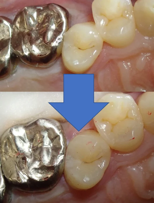 左上3本まとめてダイレクトボンディング|坂寄歯科医院(取手市藤代) - 画像7